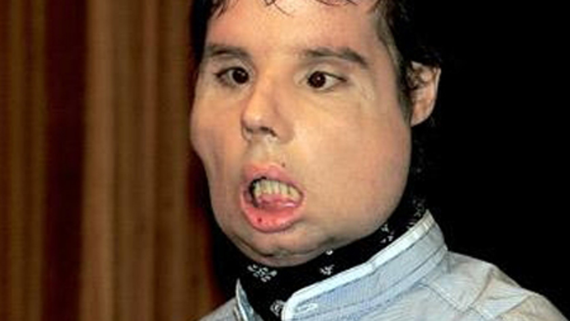 World’s first full face transplant pictures images World’s first full face transplant